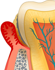 歯周ポケット.png